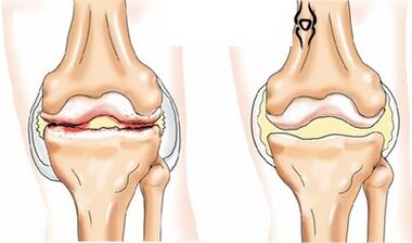 Bilateral gonartrosis