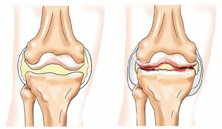 Healthy and joint articulation affected by osteoarthritis